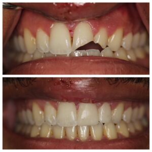 Broken teeth from a fall. Same day bonding to restore smile