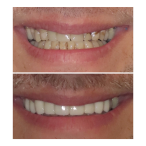 A full mouth of veneers and crowns