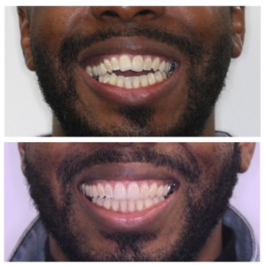 Clear aligner therapy