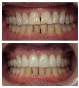 Chipped and worn teeth repaired with crowns and veneers to restore smile
