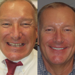 Veneers and crowns improved color and shape