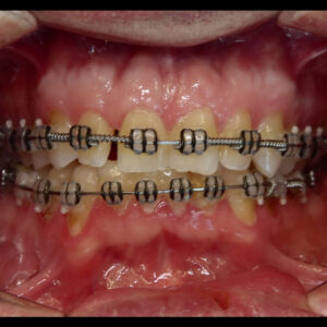 Patient came in with wire braces and was not having success